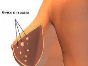 124 000 жени умират годишно от рак на гърдата