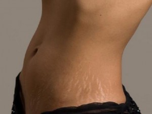 
Сензация! Мехлем на руски лечител отстранява белезите и стриите
 