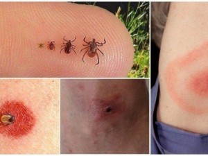 Бум на кърлежи в цялата страна
 