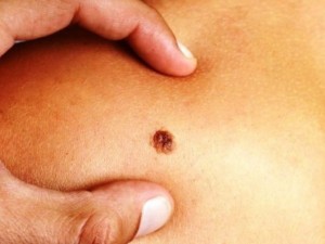 Ето кои бенки са предвестници на рака 
&nbsp;