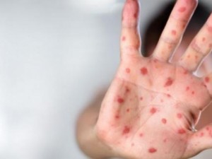 Какво трябва да знаем за маймунската шарка
