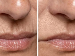 Как да премахнем бръчките около устата
