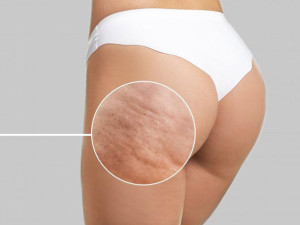 Вълшебни домашни рецепти срещу целулит
